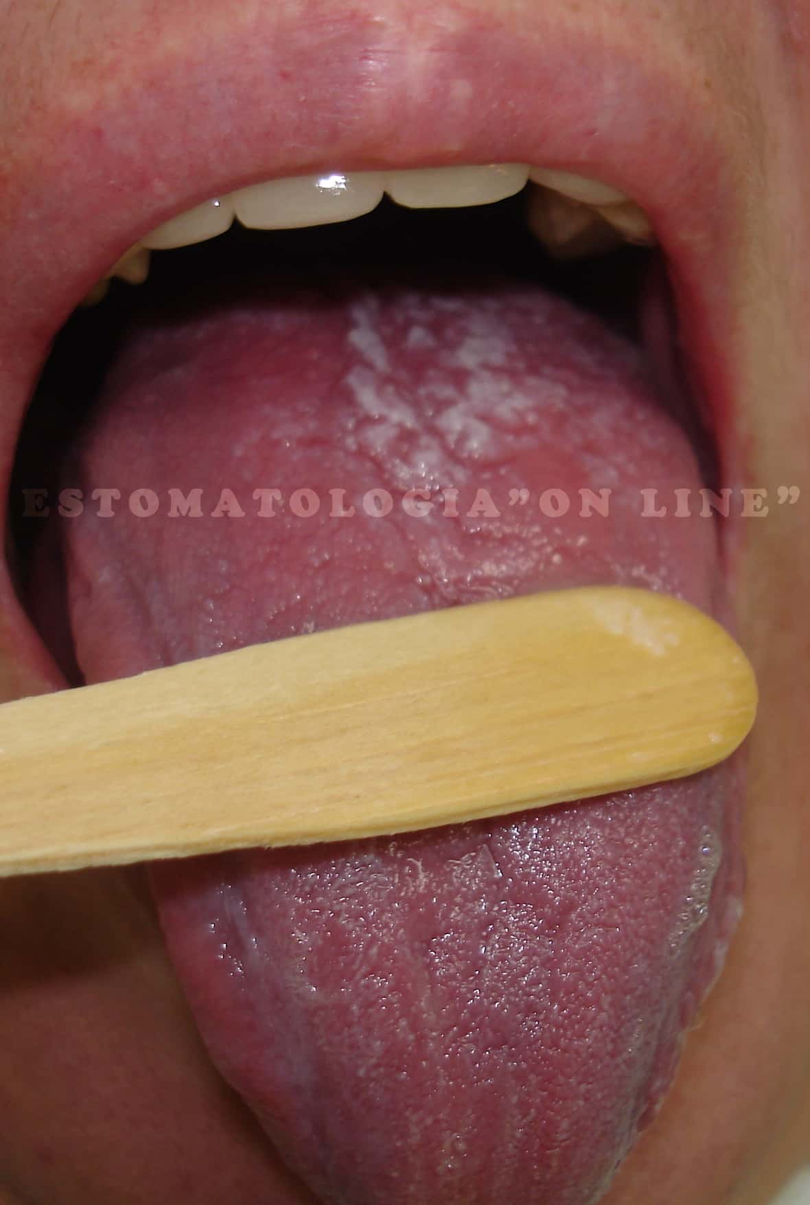 Candid Ase Candidose Oral Estomatologia On Line
