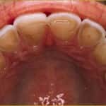 Desgaste Patológico do esmalte dental pela diminuição da quantidade e qualidade da saliva, tornando-a ácida. 