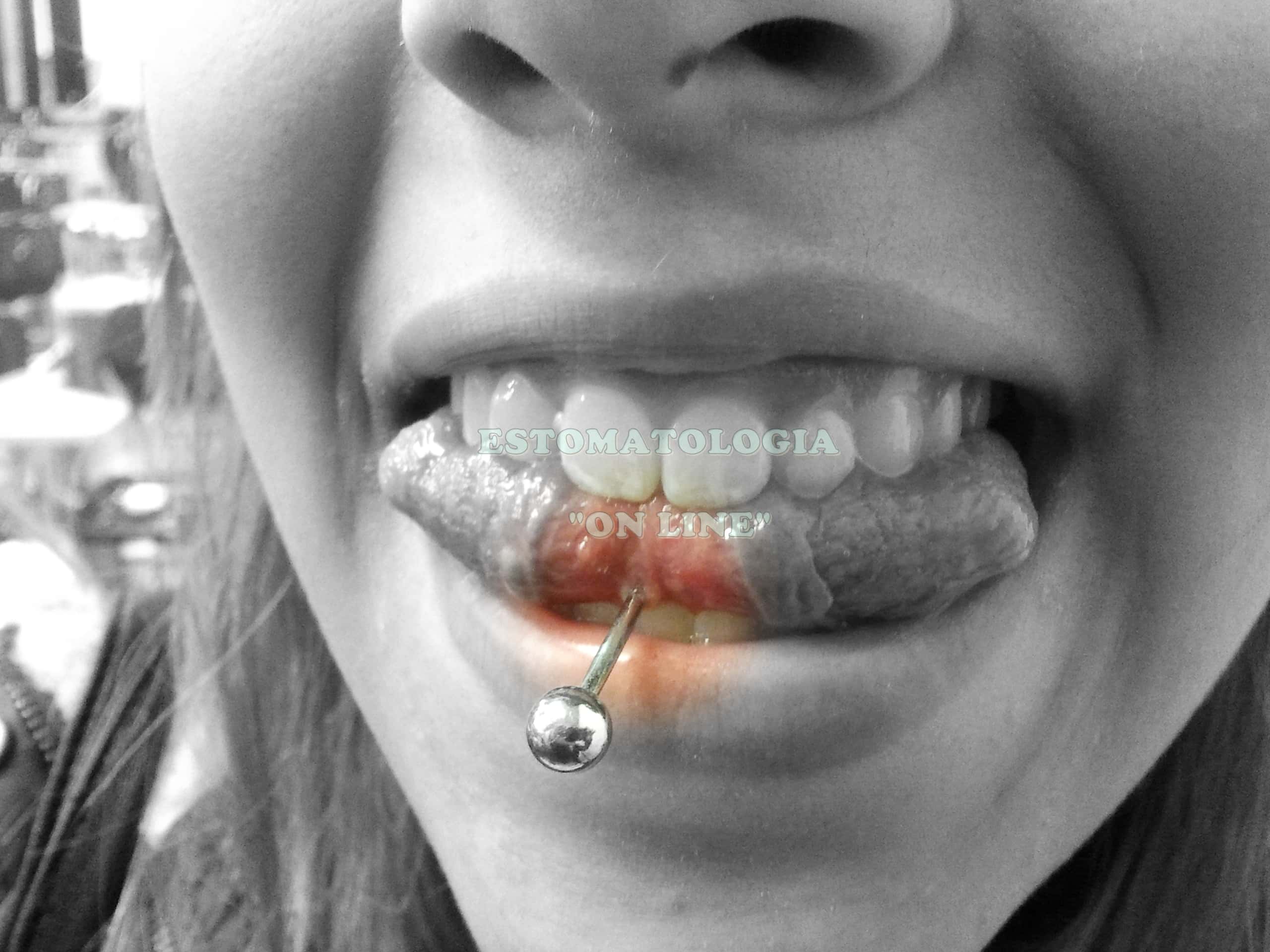 O uso de piercing oral na adolescência - Portal APCD