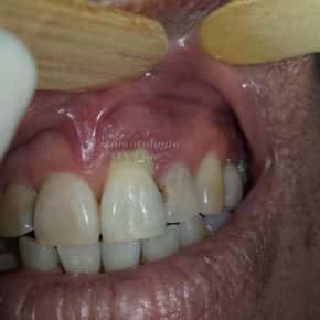 Infecções dentais e endocardite bacteriana! Cuide-se!