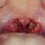 Mononucleose Infecciosa- Doença do "Beijo"