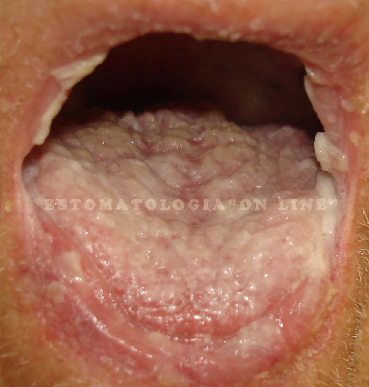 Candidíase /Candidose Oral
