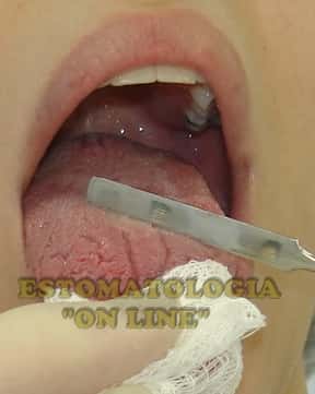 Citodiagnóstico em boca