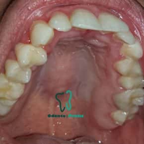 Diagnóstico e tratamento da SAB(ardência bucal)