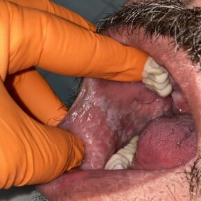 Placas brancas em mucosa bucal/oral