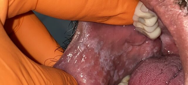 Placas brancas em mucosa bucal/oral