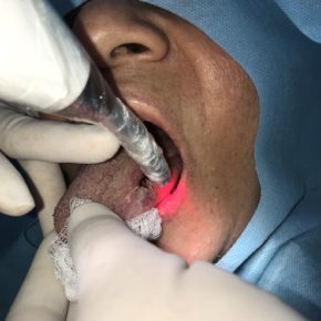 LÍQUEN PLANO bucal- diagnóstico e tratamento