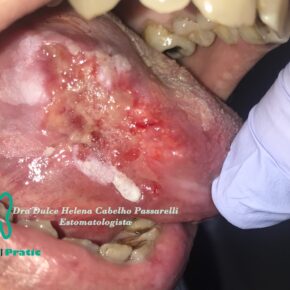 Câncer Bucal/ Câncer em boca/Carcinoma epidermoide