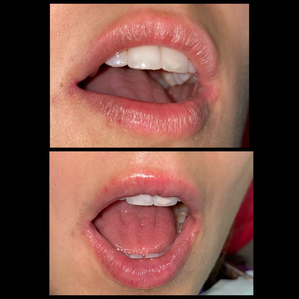 Queilite esfoliativa- antes e depois do tratamento